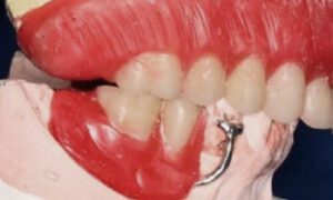 Montagem de dentes respeitando e aplicando a anatomia dental e gengival