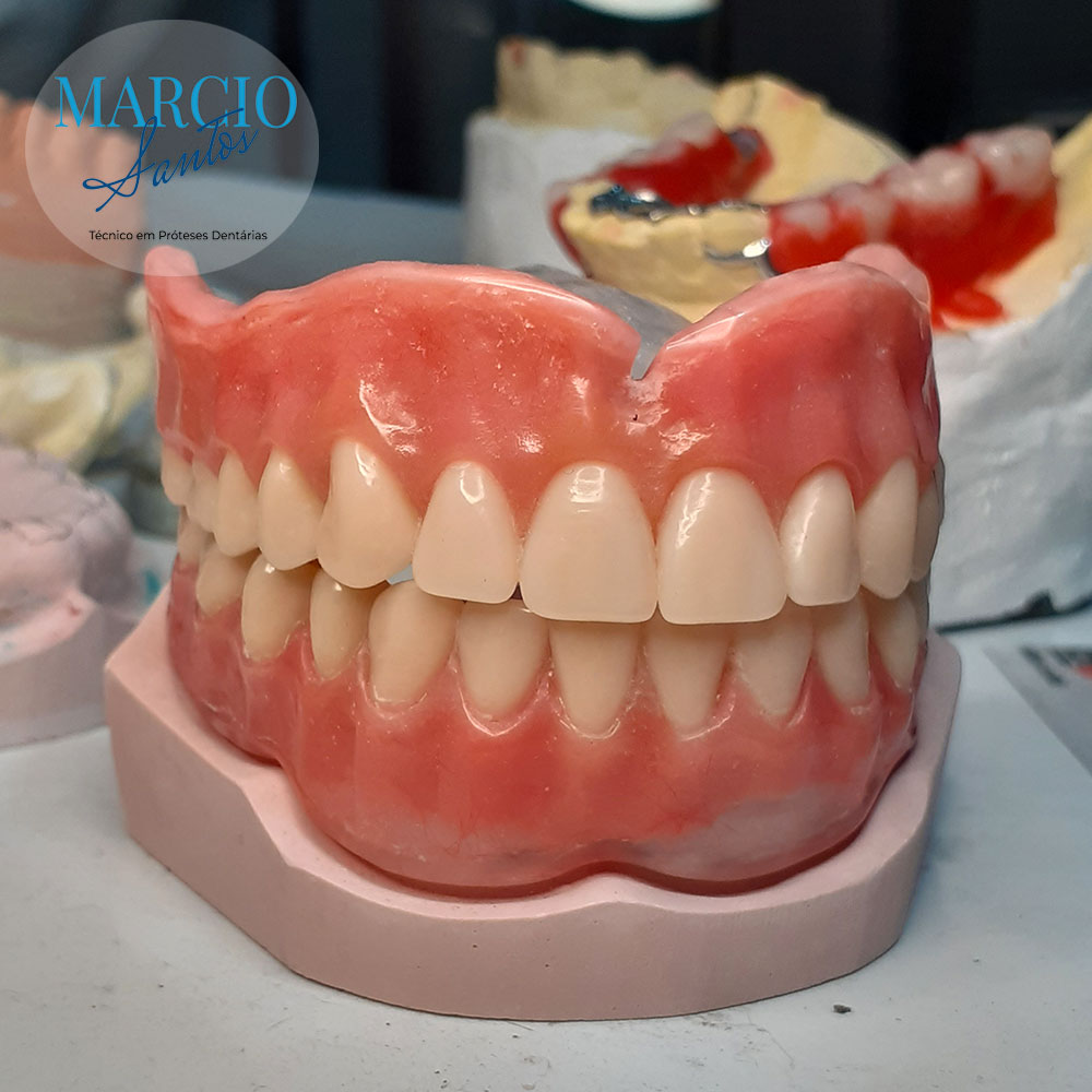 Prótese total dupla já acrilizada