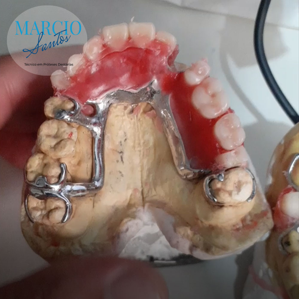 Enceramento de Prótese parcial removível (PPR)