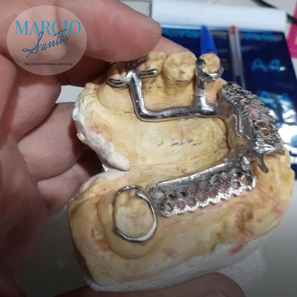 Armação de uma prótese parcial removível PPR