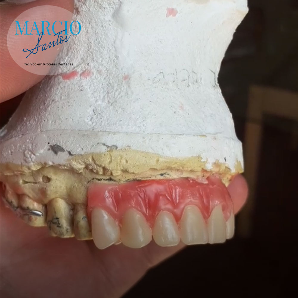 Prótese parcial removível (PPR) com enceramento