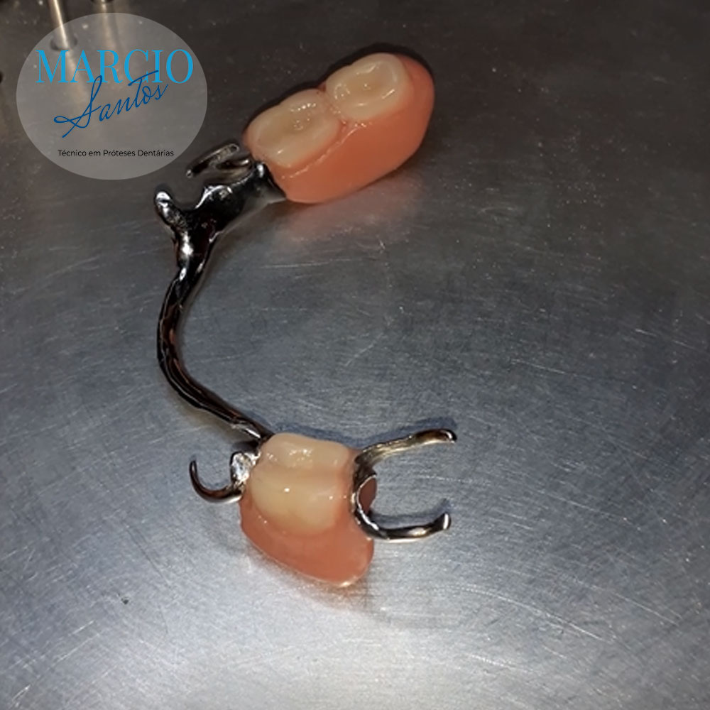 Prótese parcial removível Classe IV