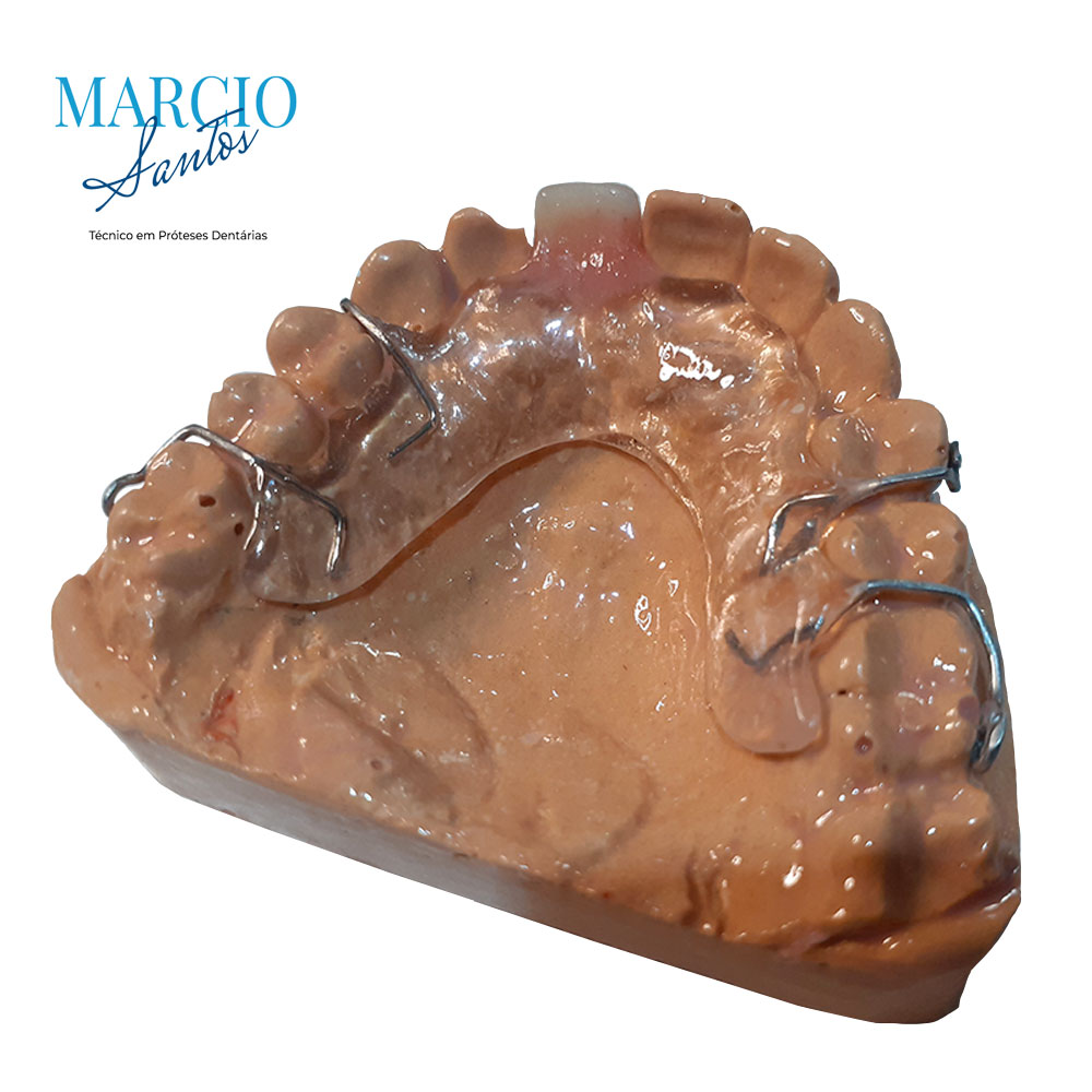 protese-parcial-removivel-provisoria-acrilica